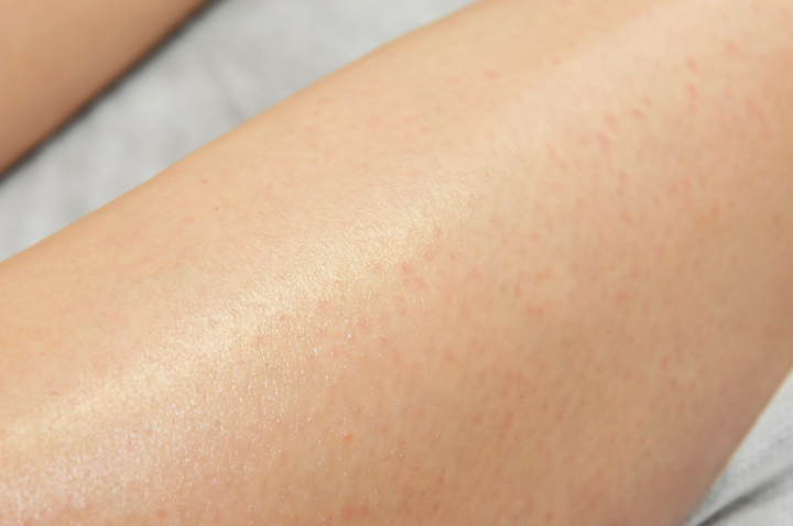 脱毛ですべすべの脚を手に入れる